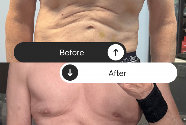 GLP-3 Fat Loss Therapy: Why Rapid No Surgery Fat Loss Is Leading the Next Generation of Medical Weight Loss