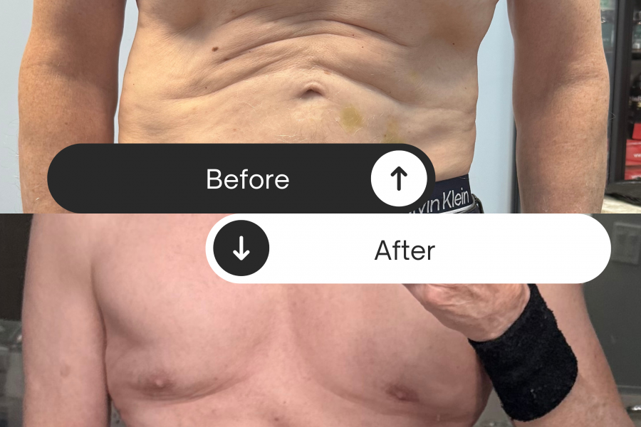 GLP-3 Fat Loss Therapy: Why Rapid No Surgery Fat Loss Is Leading the Next Generation of Medical Weight Loss