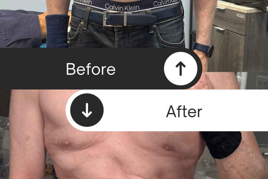 Discover the Future of Fat Loss: Why GLP-3 Therapy at Rapid No Surgery Fat Loss Is Changing Lives, Fat Loss therapy in Sarasota Florida